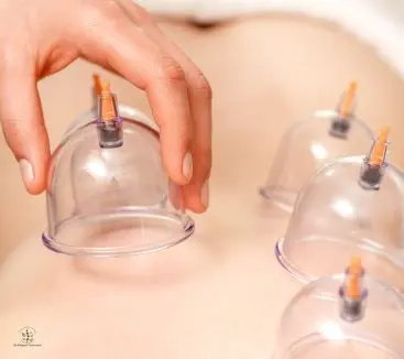 Therapist placing suction cup on a patient’s back during cupping therapy session for improved circulation and healing.