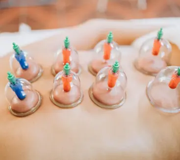 Dry cupping therapy applied on a patient’s back using vacuum suction cups for pain relief and muscle relaxation.