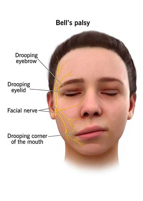 Physiotherapy treatment for Bell's palsy rehabilitation