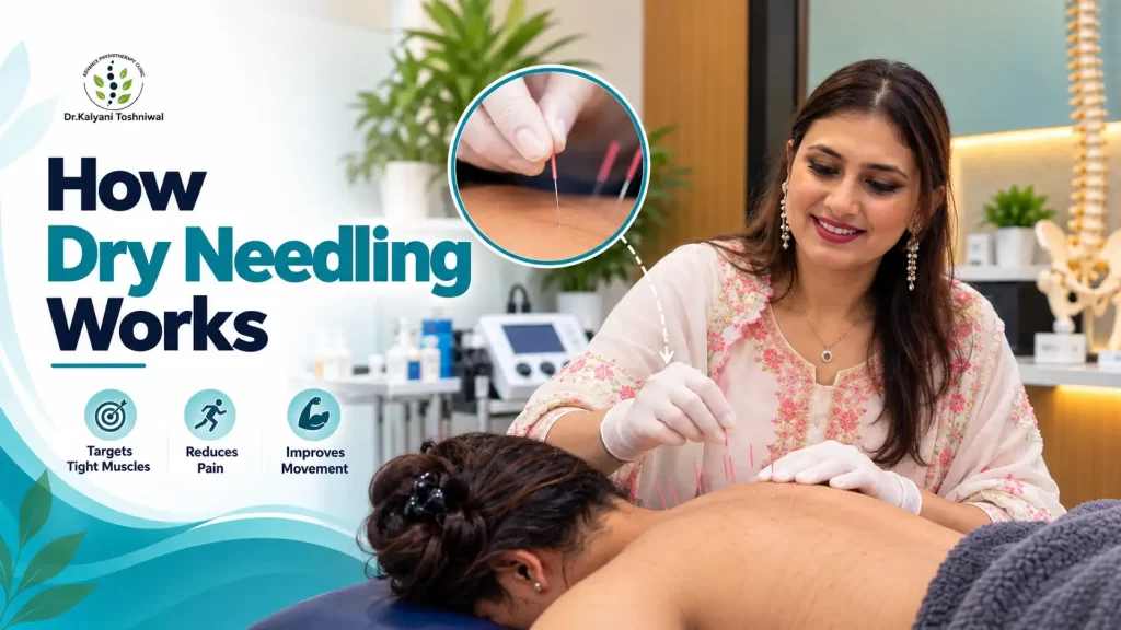 Physiotherapist demonstrating how dry needling works for upper back muscle pain